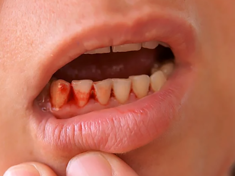Gum Disease gum-infection