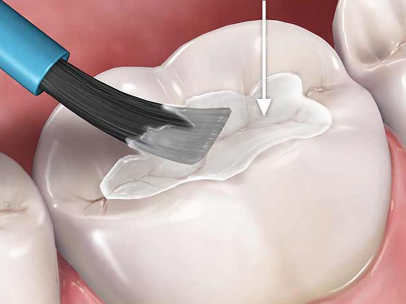Healthy gums Fissure sealant