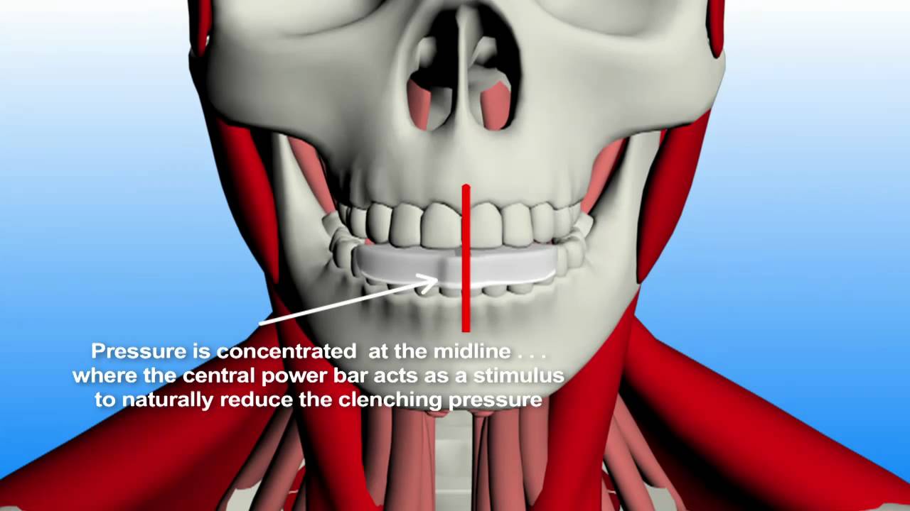 Integrated Oral Care IOC Teeth Grinding Guard
